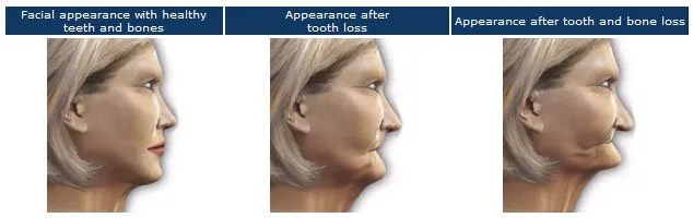Jaw Bone Loss Diagram