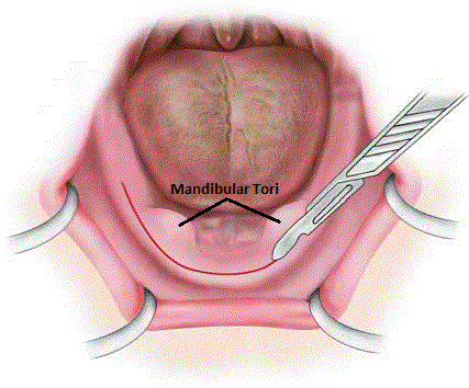 Mandibular Tori Diagram