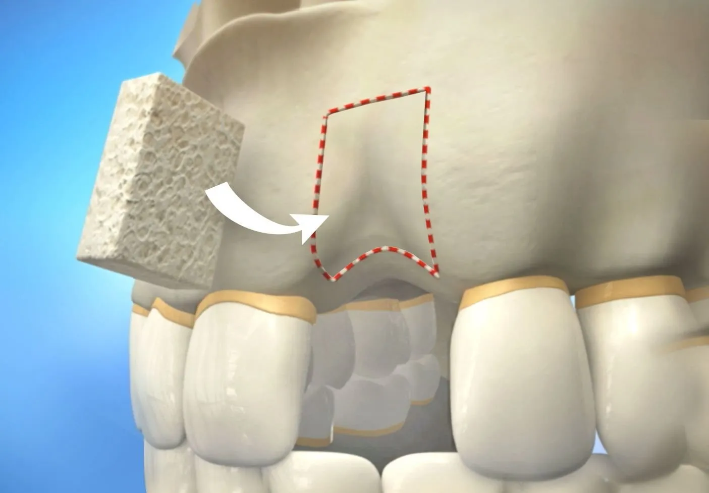 Dental Bone Grafting Diagram